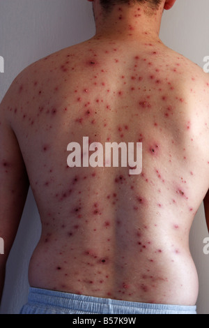 'Chicken pox' virus, back of adult man covered in itchy red spots Stock Photo