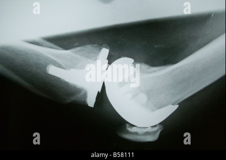 X-ray of  'Total knee arthroplasty' prosthesis. Stock Photo