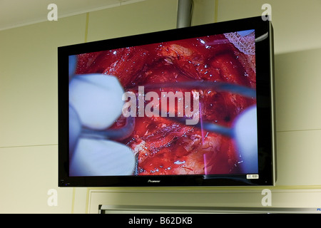 Close up of computer screen showing neurosurgeons working on removing benign brain tumor, Reykjavik, Iceland Stock Photo