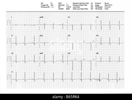 Result from a Treadmill Stress Test. Regular low heartbeat (73bpm) on rest phase (male, 34y). More info on the top of the image. Stock Photo