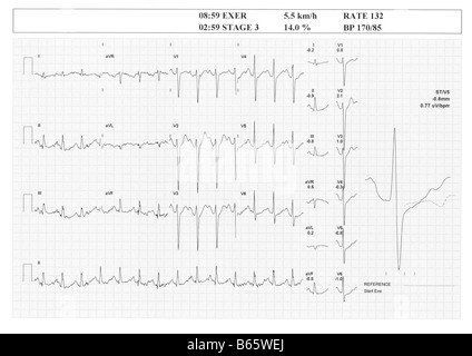 Result of a Treadmill Stress Test. Regular high heartbeat (132bpm) on exercise phase (male, 34y). Info on the top of the image. Stock Photo