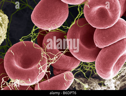 Blood clot, coloured scanning electron micrograph (SEM). Red blood cells are red and fibrin proteinstrands are green Stock Photo