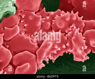 Crenated blood clot, coloured scanning electron micrograph (SEM). Red blood cells are red and fibrin proteinstrands are green Stock Photo