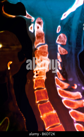 Arthritis of the spine. Frontal coloured 3D computed tomography (CT) scan of the spine of a 75year old with osteoarthritis. Stock Photo