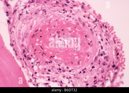 Blood clot. Light micrograph of a section through a human artery, showing a large thrombus due to cryoglobulinemia. Stock Photo