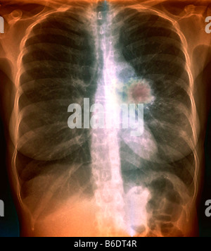 x-ray showing lung cancer in an 80 year old man with a long history ...