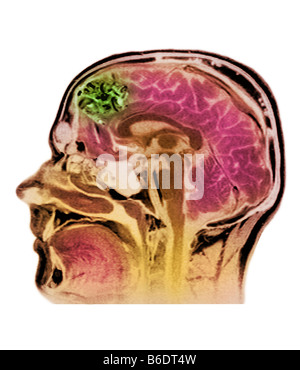 Blood vessel tumour. Coloured magneticresonance imaging (MRI) head scan showing anarter Stock Photo