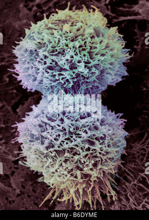 Cervical cancer cell. Coloured scanning electron micrograph (SEM) of a dividing cervical cancer cell. Stock Photo
