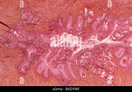 Cervical cancer. Light micrograph of a section through a cervix showing invasive carcinoma, a form of cancer (across centre). Stock Photo