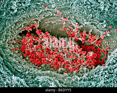 Blood clot, Coloured scanning electron micrograph (SEM) of blood clotting in an ovarian follicle. Stock Photo