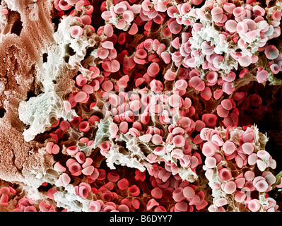 Blood clot, Coloured scanning electron micrograph (SEM) of blood clotting in an ovarian follicle. Stock Photo