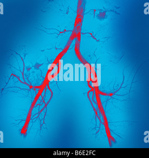Normal abdominal arteries. Coloured angiogram(blood vessel X-ray) of arteries in the pelvic region. Stock Photo
