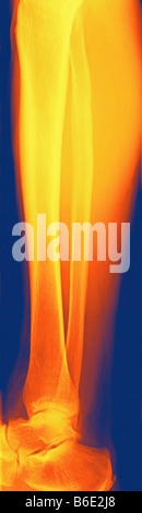 Normal lower leg, coloured frontal X-ray. Stock Photo