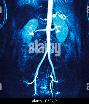 Normal renal arteries. Coloured magnetic resonanceangiogram (MRA) of the arteries supplying the kidneys Stock Photo