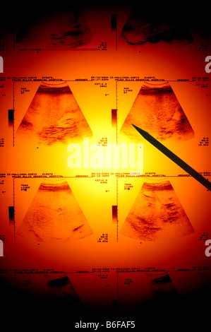 doctor pointing at ultrasound diagnostic screen of a heart Stock Photo