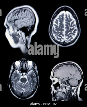 High Resolution MRI MRA Magnetic Resonance Angiogram of the brain vasculature arteries CRT Monitor Grain Visible Stock Photo