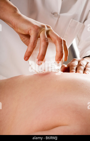 Close up of acupuncturist's hands performing vacuum cupping Stock Photo