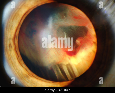 eye image showing retinal detachment Stock Photo