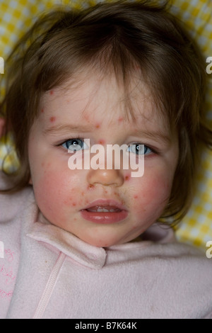 Chickenpox. Symptoms of the child Stock Photo - Alamy