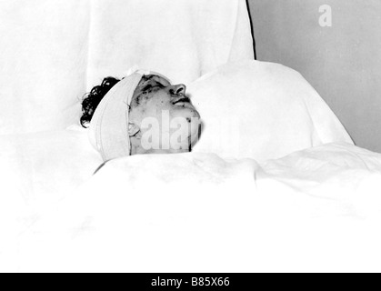 Piaf at the Rambouillet hospital after her car accident, September 7, 1958 Stock Photo