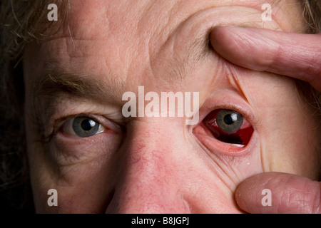 Bloodshot eye following hypertensive episode Stock Photo