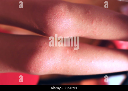 2 Year Old Child's Legs Showing Allergic Reaction to Medicine (Amoxicillin)