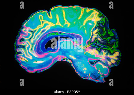 Artificially Coloured MRI Scan Of Human Brain Stock Photo