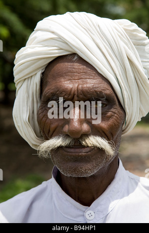 Sihk man with an eye cataract. Surat, Gujarat. India.