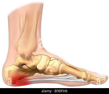 Plantar Fasciitis. Illustration human foot anatomy explain on symptom ...