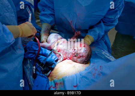 Baby being delivered by caesarean section. Stock Photo