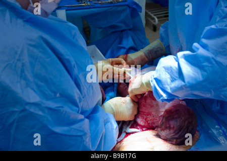 Baby being delivered by caesarean section Stock Photo
