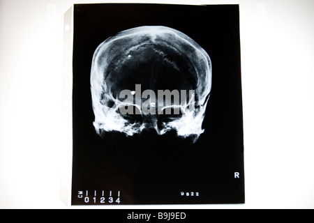 X-ray of human skull with foreign fragments Stock Photo