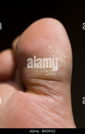 Close up of cracked skin of man's toe Stock Photo