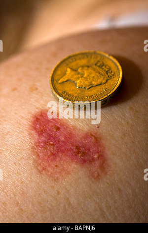 Basal Cell Carcinoma Stock Photo