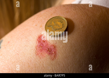 Basal Cell Carcinoma Stock Photo