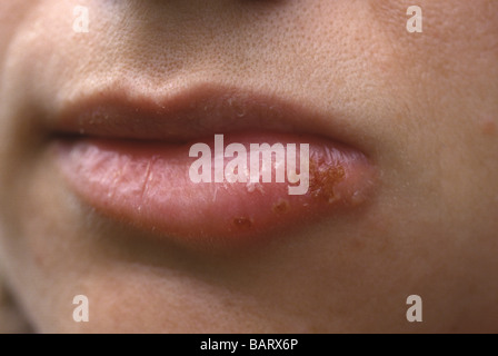 close-up of a woman's lips with a cold sore, coldsore,  inflammation on bottom lip Stock Photo