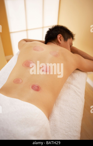 Cupping. Client with red marks on his back after receiving cupping therapy. Stock Photo