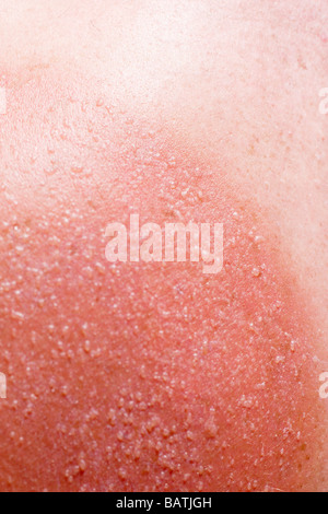 Sunburnt skin on a man'sshoulders. Sunburn is caused by overexposure to sunlight. Stock Photo