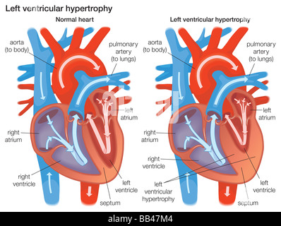 Cross section comparing the left ventricular wall of normal heart to a left ventricular wall that has experienced hypertrophy. Stock Photo