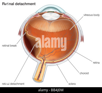 Diagram of a retinal detachment. Stock Photo