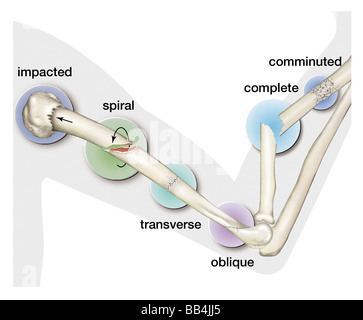 Types of fractures of bones. Stock Photo