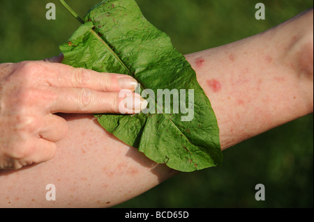 Treating a nettle sting with a Dock Leaf Stock Photo