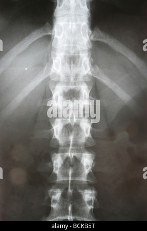 X-ray of the pelvis and spinal column Stock Photo - Alamy