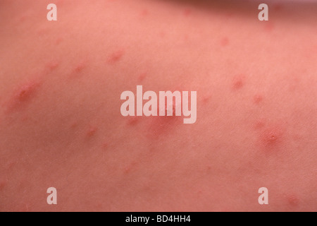 close up lesions of chicken pox on child s skin Stock Photo