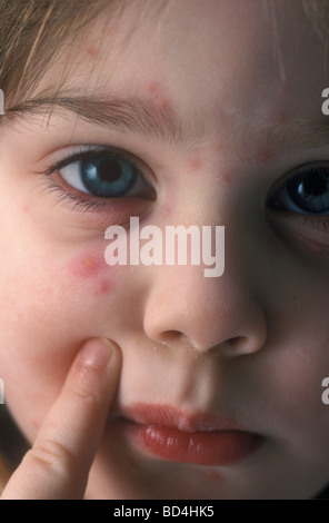 close-up of chicken pox lesions on a little girl's face below her eye Stock Photo