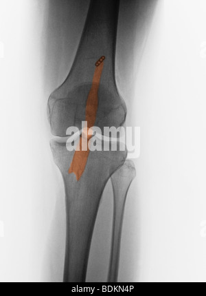 x-ray showing the repair of a torn anterior cruciate ligament in a 28 year old woman Stock Photo