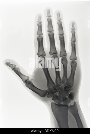 x-ray of the hand of a 36 year old man, normal Stock Photo