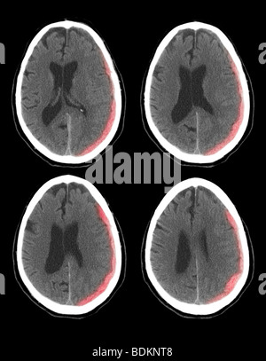 CT scan of the brain of a 73 year old man show intracranial bleeding Stock Photo