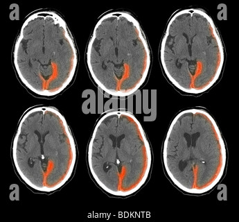 CT scan of the brain of a 73 year old man show intracranial bleeding Stock Photo