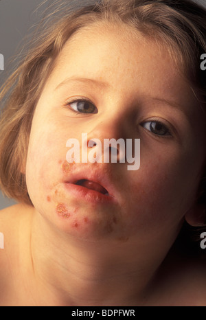 little girl with impetigo scabs on her face Stock Photo